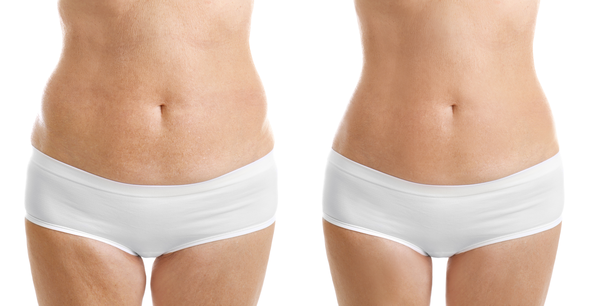 Liposuction vs. Liposculpture: Which Option is Best For Your Body?