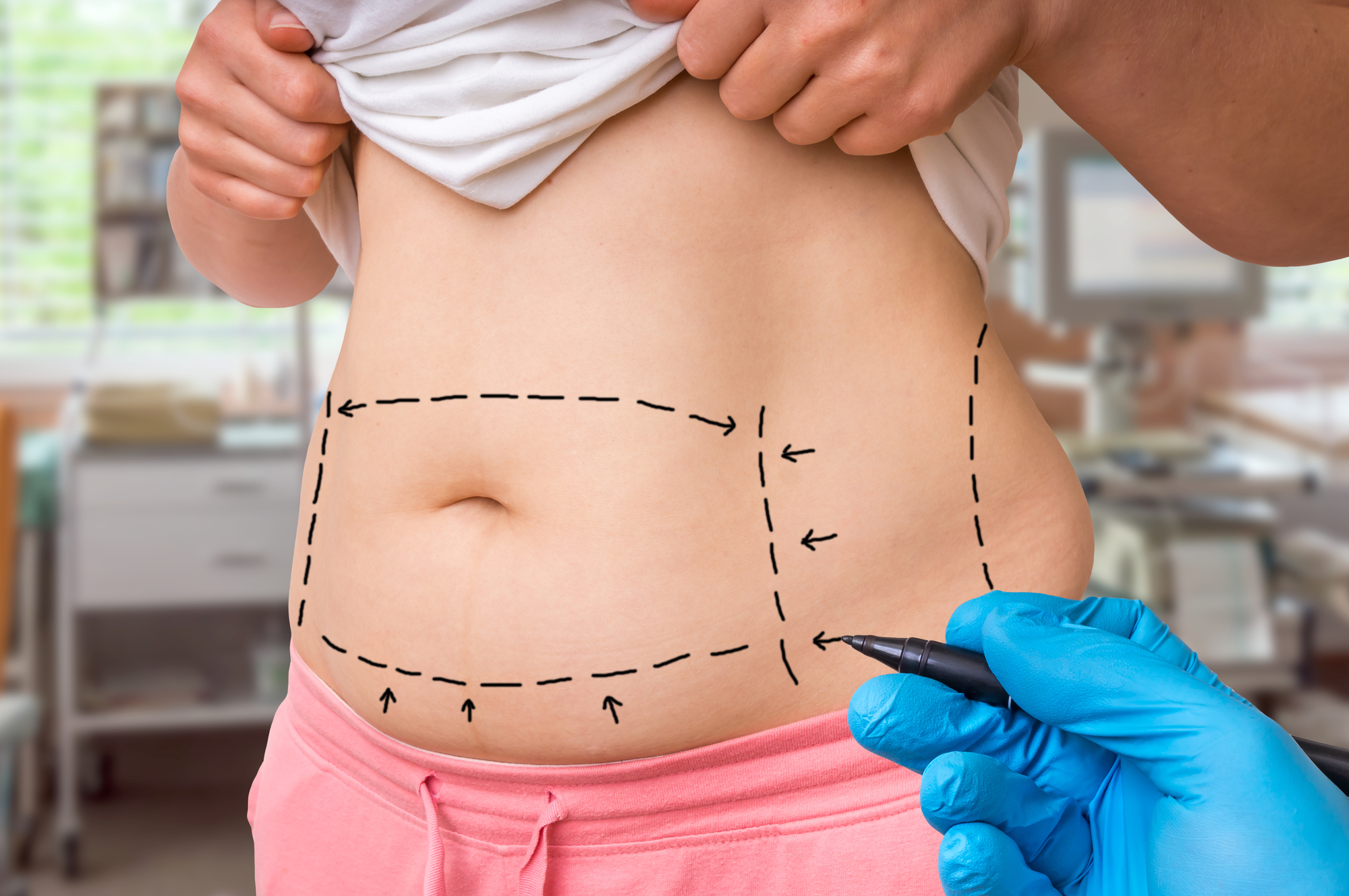 How to Reduce the Appearance of Your Tummy Tuck Scars - Berlet